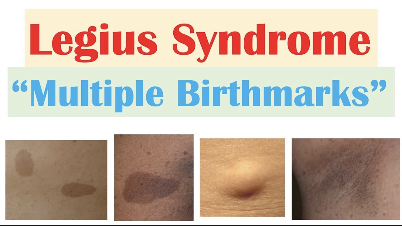 “Inherited Condition with Many Birthmarks” | Legius Syndrome | Symptoms, Diagnosis, Treatment