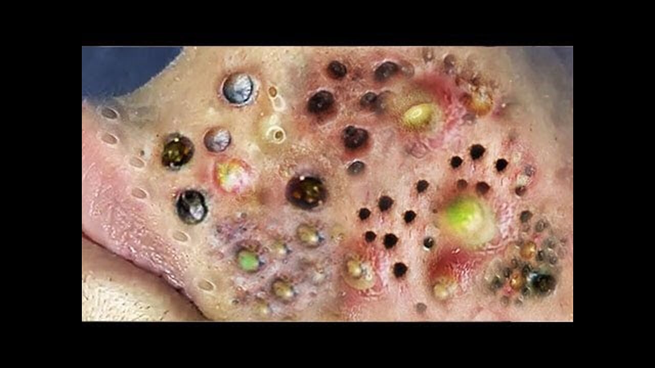 Super Satisfying Blackhead Removal