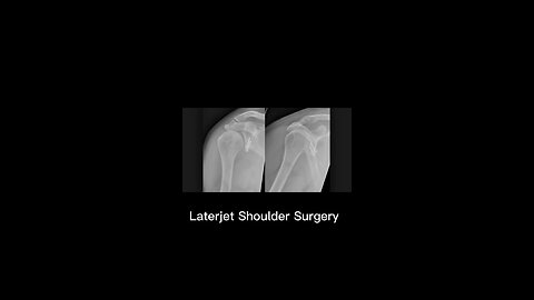 Laterjet Shoulder Surgery (My experience)