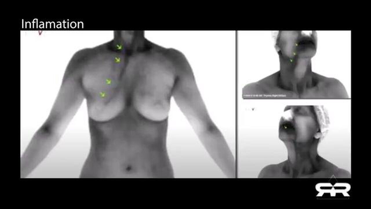 THERMOGRAPHIC IMAGING SHOWS MASSIVE BLOOD CLOTS IN THE JABBED