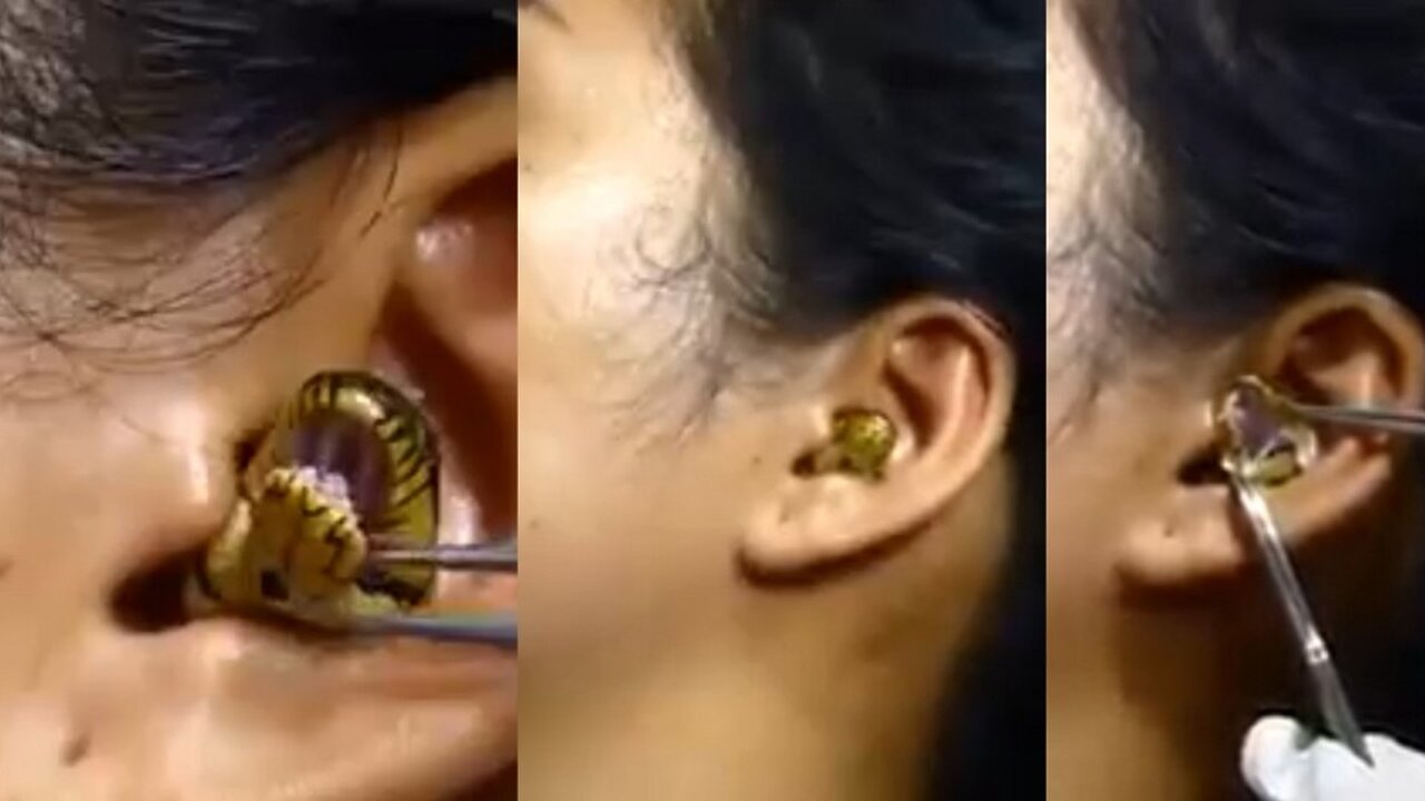 ‘Surgeon’ struggles to remove live snake from woman’s ear in viral video