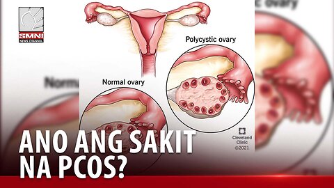 ALAMIN | Ano nga ba ang sakit na PCOS?