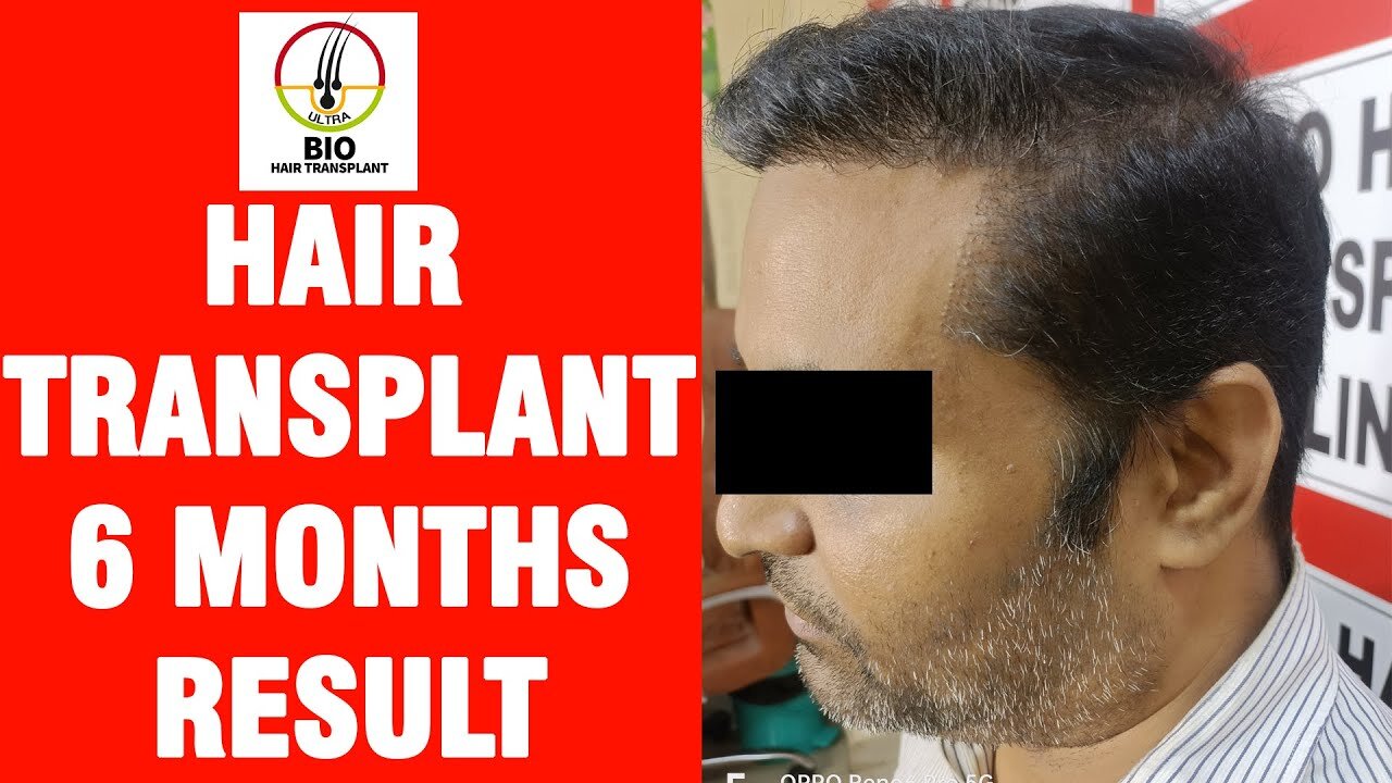 Hair Transplant 6 Months Results