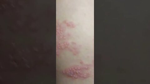 Monkeypox