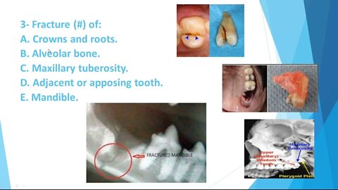 Oral Surgery L14 (Complications of Exodontia)