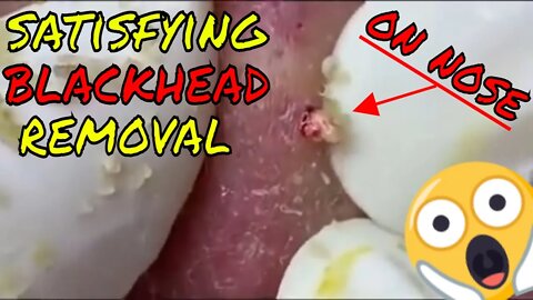 Satisfying blackhead removal on nose 👃🪱 #blackheadremoval #blackhead #blackheads #satisfying