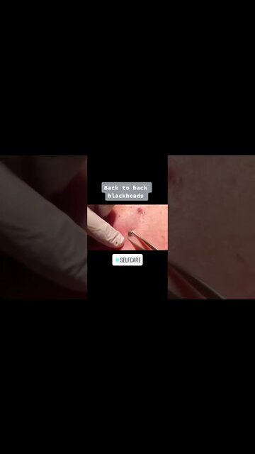 Blackheads Removal on the Back PART 3