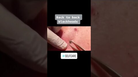 Blackheads Removal on the Back PART 3