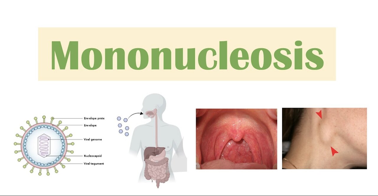 Infectious Mononucleosis (Mono) | Epstein-Barr Virus, Transmission, Symptoms, Diagnosis, Treatment