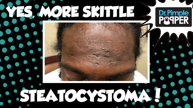 YES, More Skittle Steatocystoma - Session 6