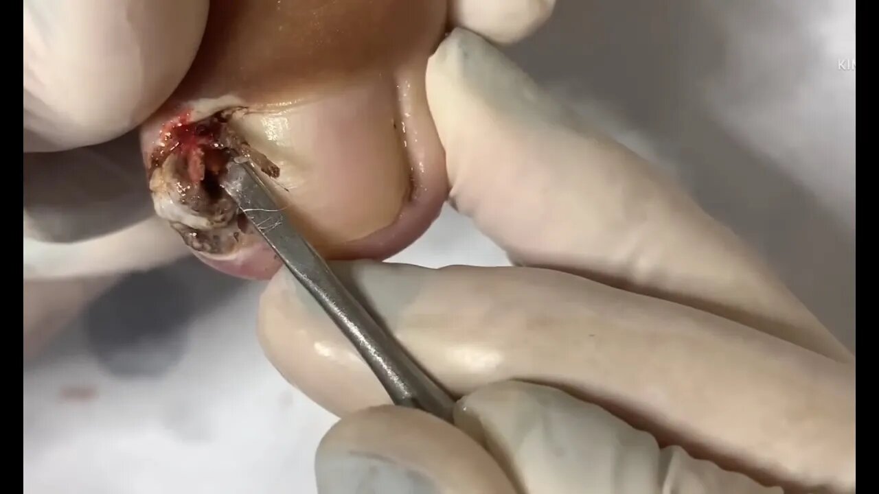 2 unhas muito encravadas | 2 very ingrown nails #nails #podologia #dor