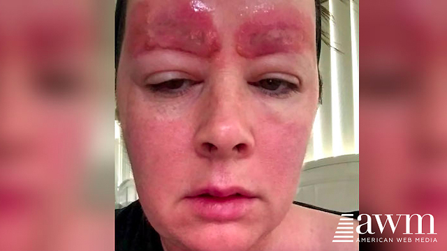 Woman’s Skin Falls Off Her After Technician Messes Up Basic Procedure, Warns Others Are Next