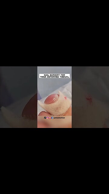 NAIL SURGERY FOR THICK DEFORMED TOENAIL 2023 BY FOOT DOCTOR MISS FOOT FIXER