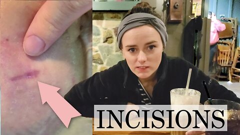 Incisions are Healing | Let's Talk IBD