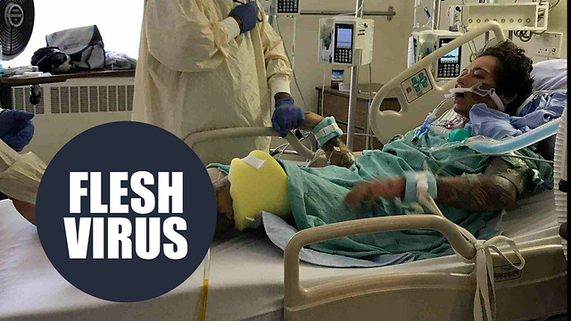 Woman who scratched her leg on a rusty nail is struck down by a flesh-eating bug