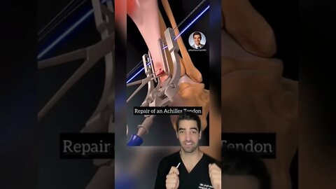 Achilles Tendon Repair