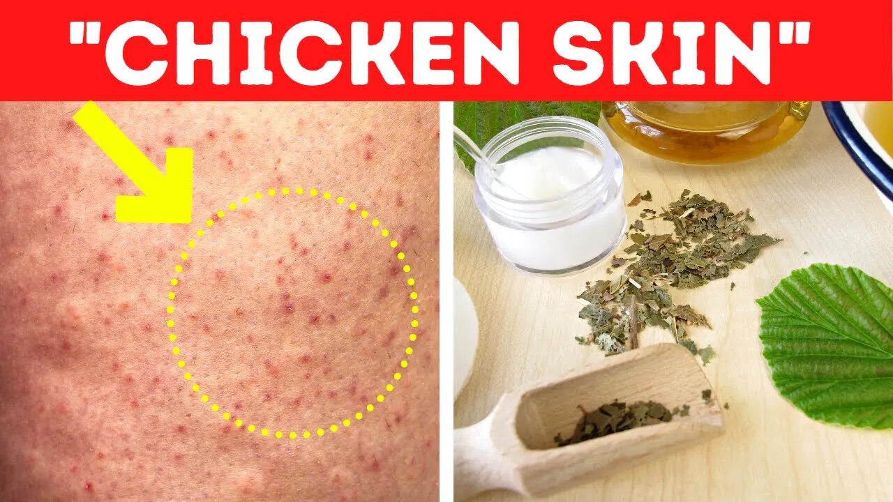 Here's How To Get Rid Of Chicken Skin Fast (Keratosis Pilaris)