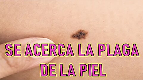 SE ACERCA LA PLAGA DE LA PIEL - JESUCRISTO REY A SHELLEY ANNA
