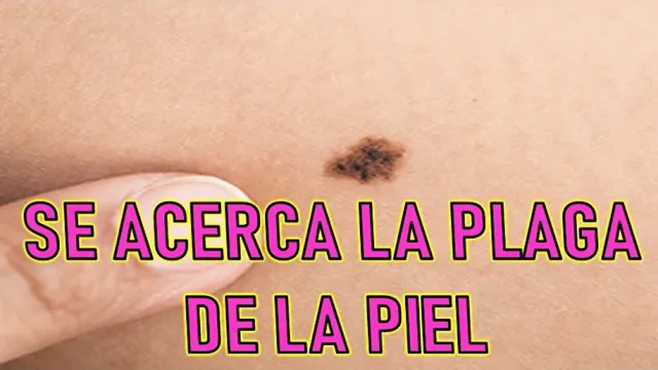 SE ACERCA LA PLAGA DE LA PIEL - JESUCRISTO REY A SHELLEY ANNA