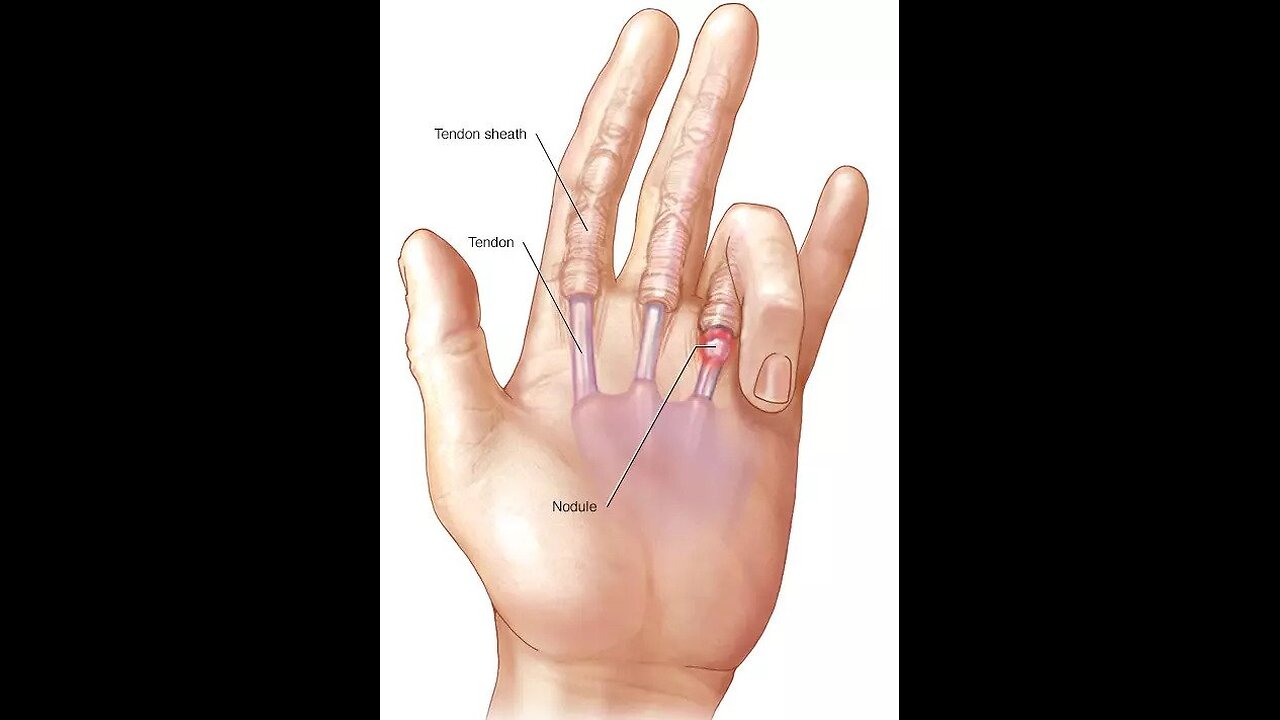 What is Trigger Finger? It's symptoms, affects and treatment.
