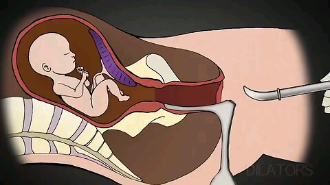 Abortion Process ▪️ 1-minute Explanation & Description 👀👹☠️🤢