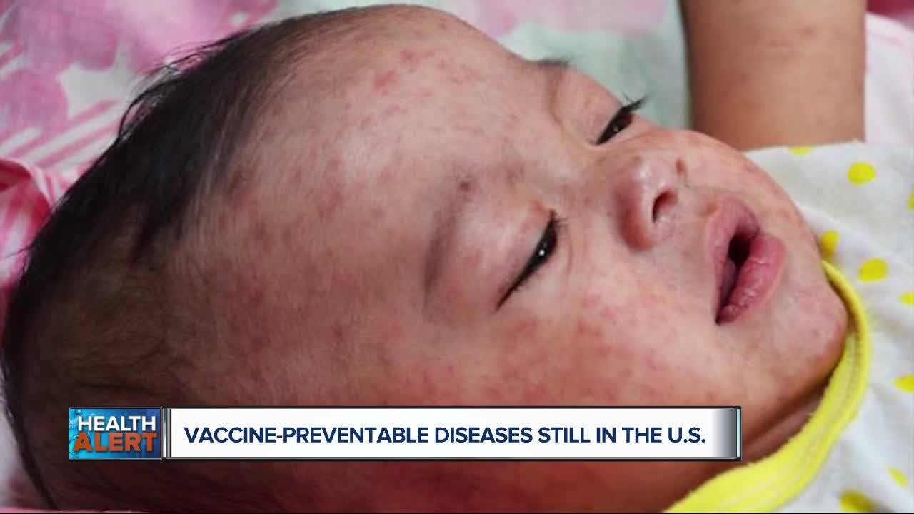 It's not just measles: Tetanus, Mumps and other vaccine-preventable diseases are still in the US