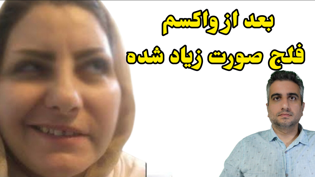 بعد از واکسم فلج صورت زیاد شده !