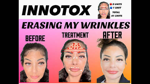 Innotox-Toxin Touch-Up and My Techniques #diy