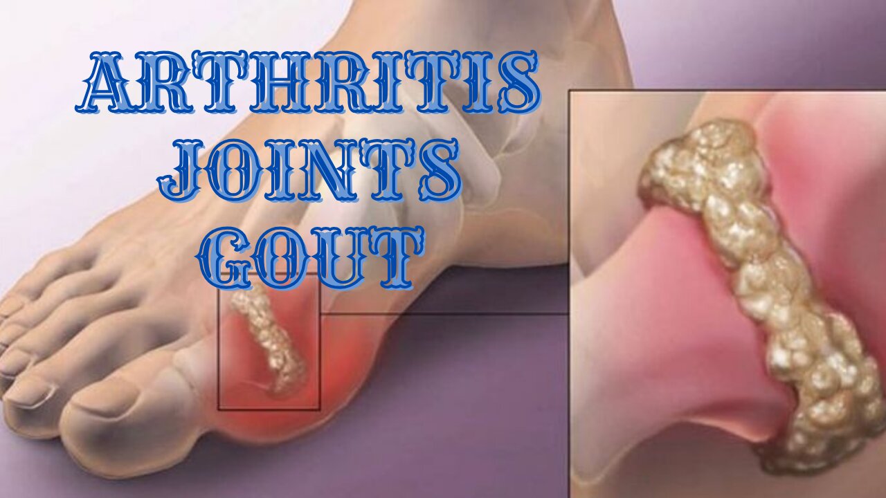 💫Healing of Tissues, Bones and Joints💫Uric Acid Normalizes and Gout Disappears💫Gout💫