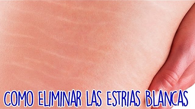 Como Eliminar Las Estrias Blancas