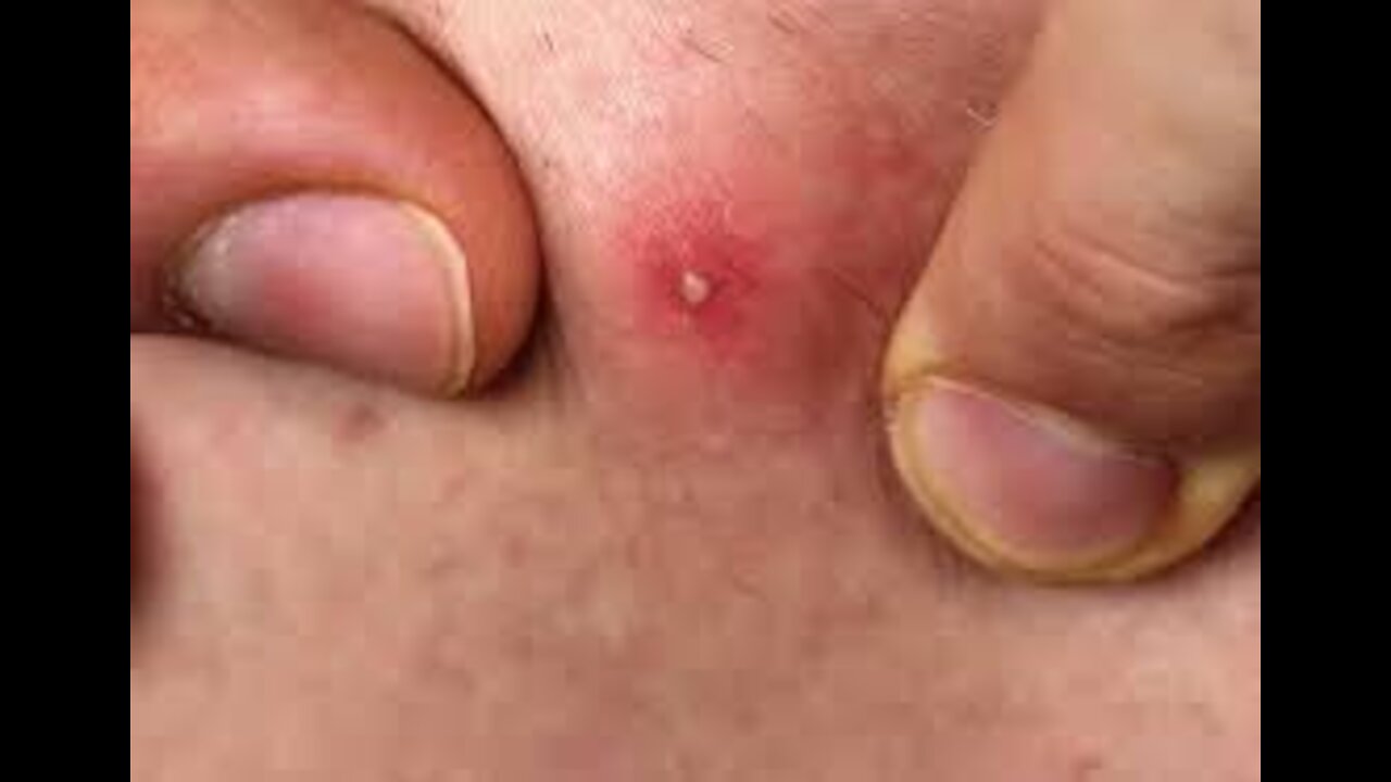 #BIGPIMPLES, #INFECTION#PIMPLES