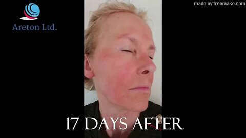 Areton Plasma Treatment Jaw line & Under EyeLid Tightening for Aesthetic Purposes, Wrinkles Removal