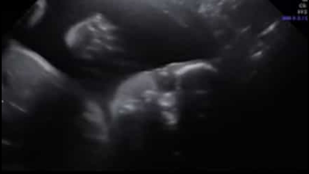 Un bébé fait coucou pendant l'échographie