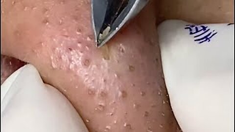 Relaxing, Satisfying, blackheads, tweezers, acne treatmen of pimple popper 105