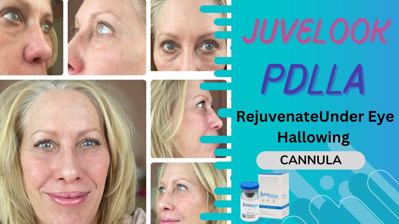 Juvelook PDLLA for Under Eye Hollowing Before & After Results