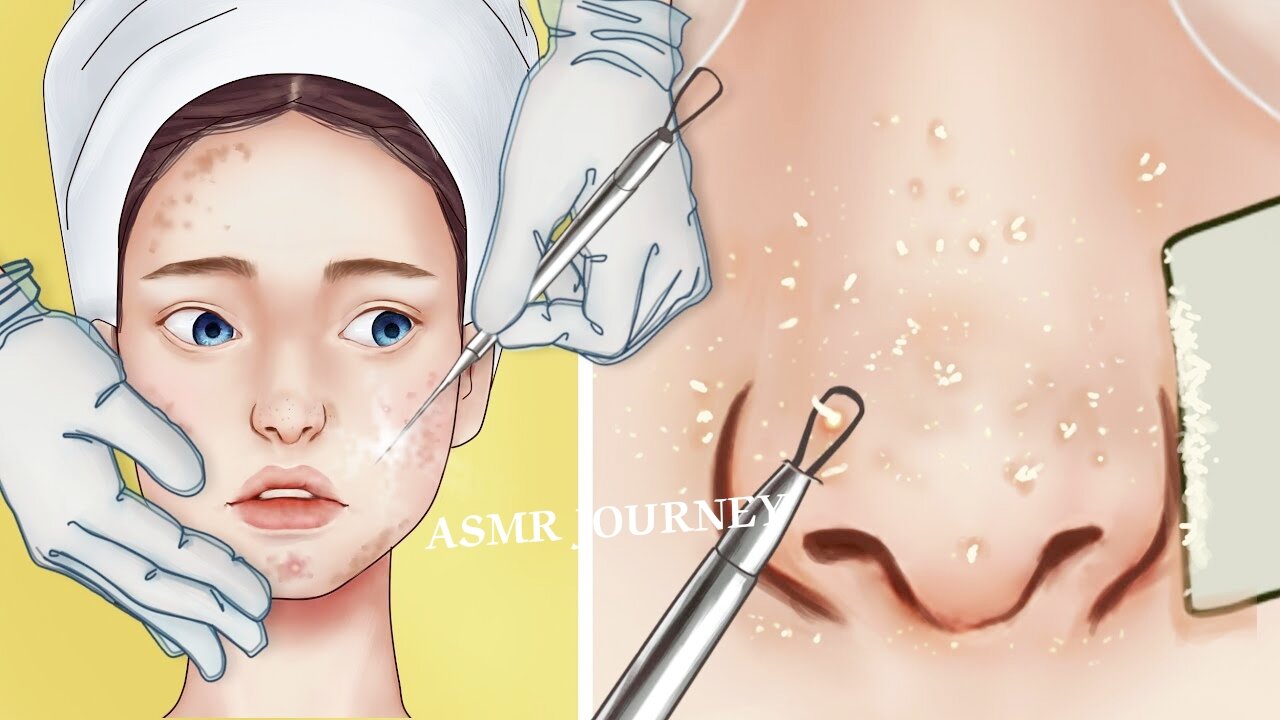 ASMR FACE PIMPLES REMOVAL ANIMATION || ASMR treatment || #asmr #asmrtreatment #asmrsounds