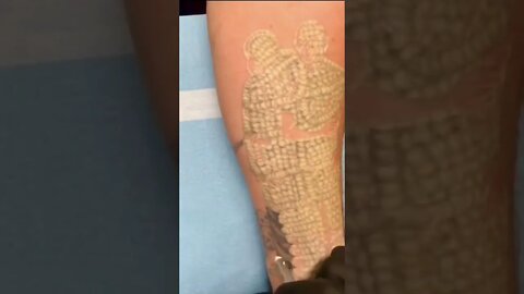 Tattoo removal in under two minutes