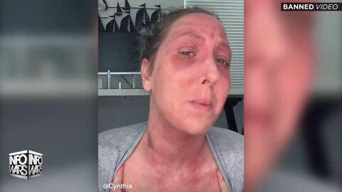 Woman Warns The World How Covid Vaccine Destroyed Her Life