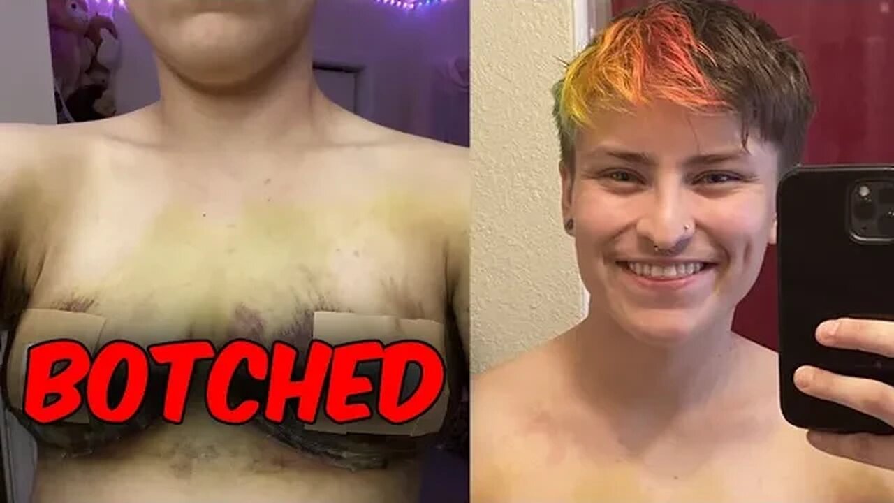 Botched "Top Surgery" job and the Surgeon Dismisses Her Concern