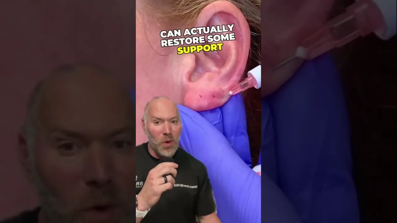 Using Filler to Restore Earlobes 👂 #shorts