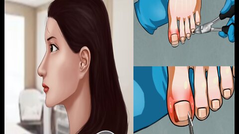 ASMR Ingrown Toenail removal treatment animation