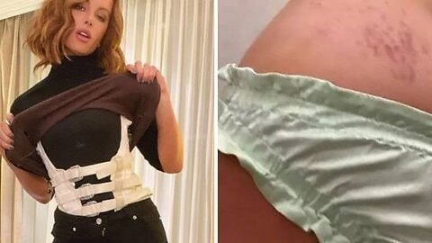 Kate Beckinsale posts disturbing photos of bruises and injury on body: What happened to her