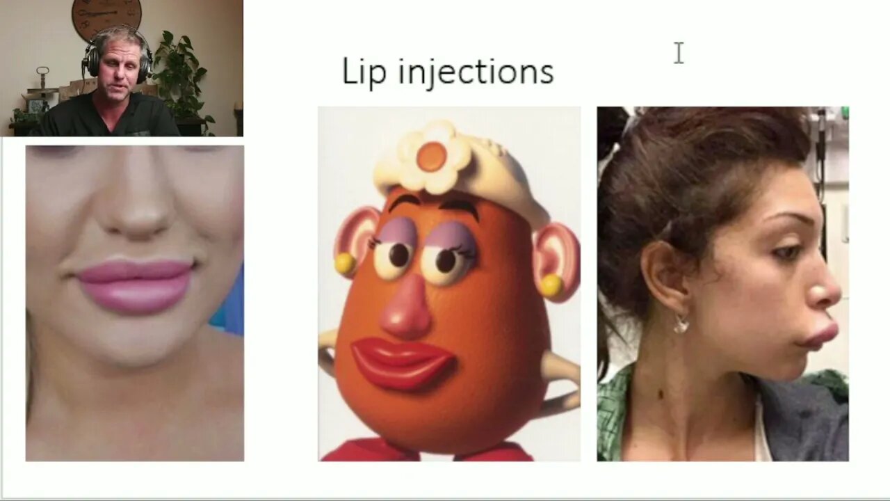 Lip Injections