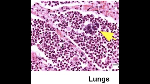 "Global Time Bomb" First case of postmortem study - "viral RNA found in every organ of the body"