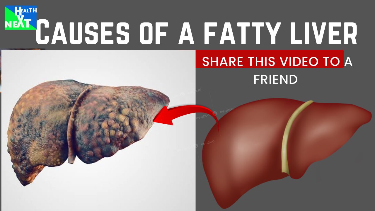 MANY DONT WANT TO WATCH THIS VIDEO,CAUSES OF A FATTY LIVER