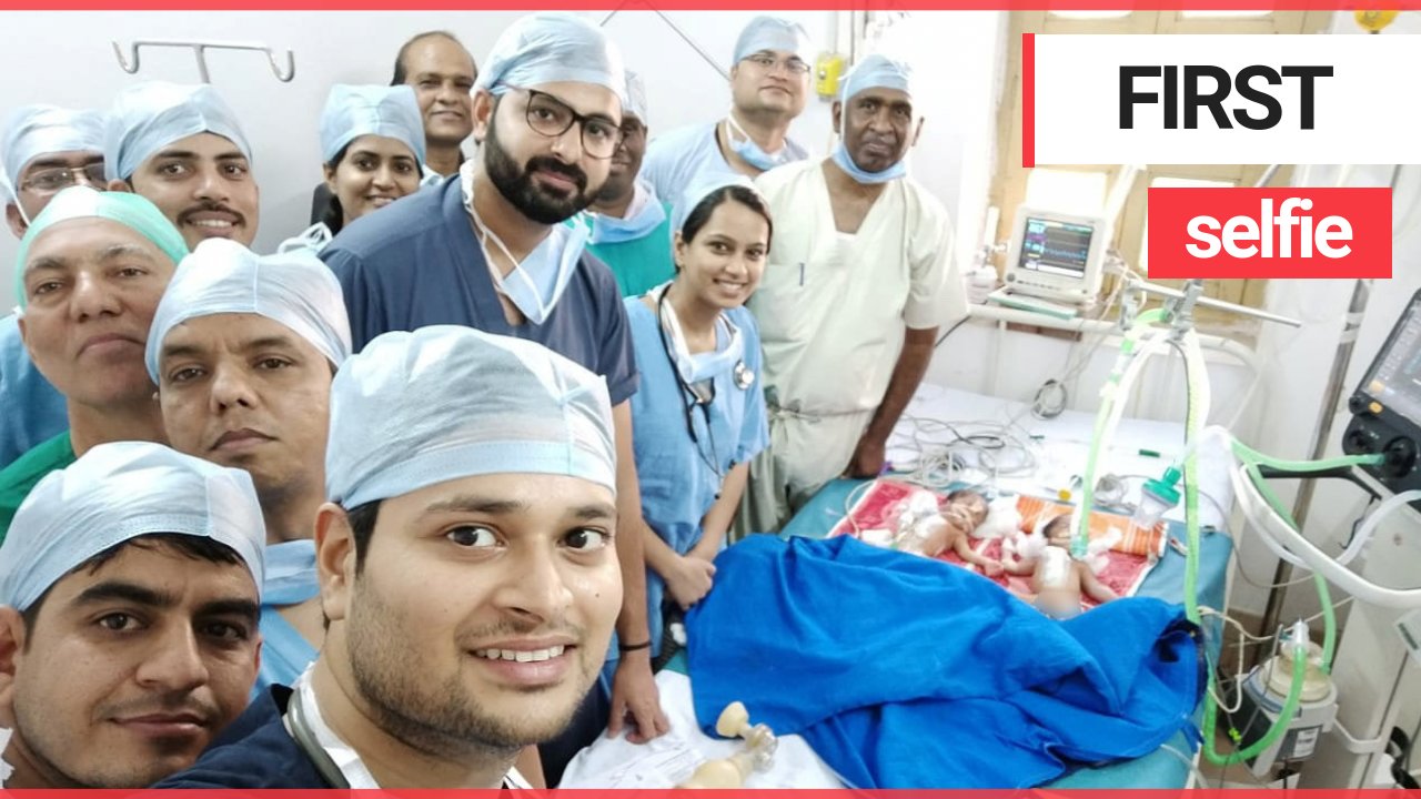 Surgeons separated 3-day-old conjoined twins in painstaking operation