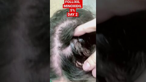 FOLLIXIL MINOXIDIL 5% DAY 2 #djonoedit #sad #hairhairhair #stephaniemouhadi #azam #zinabtahertolodel