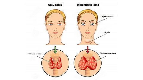 HIPERTIROIDISMO BIODESCODIFICACION Y LA SOLUCION A ESTA ENFERMEDAD