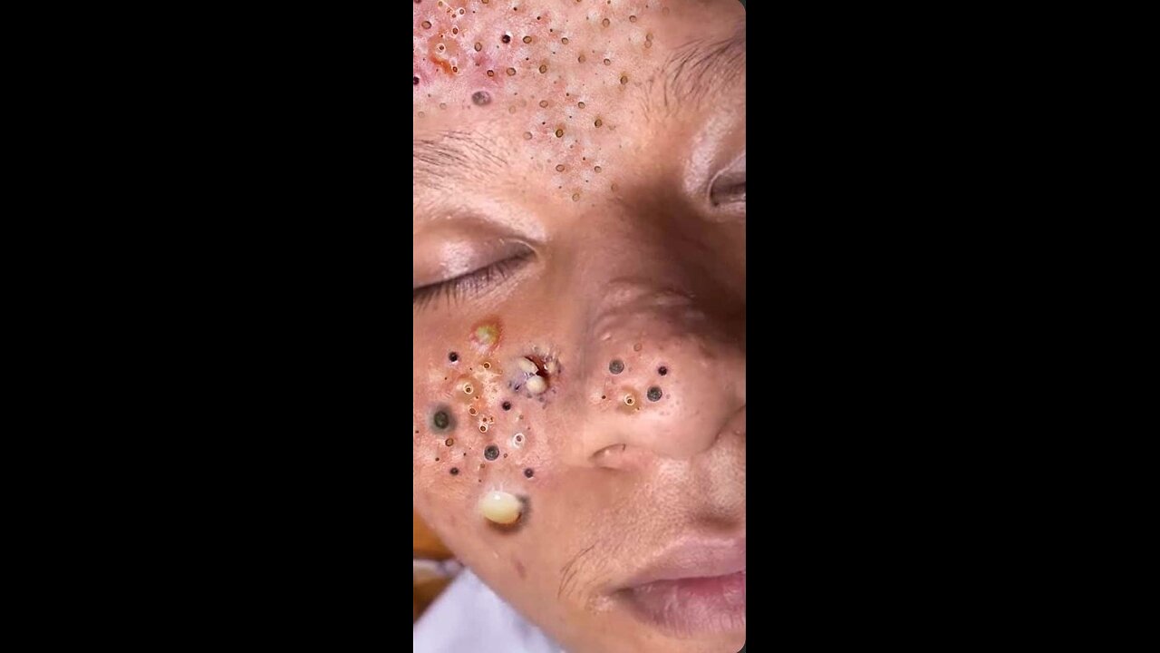 blackhead