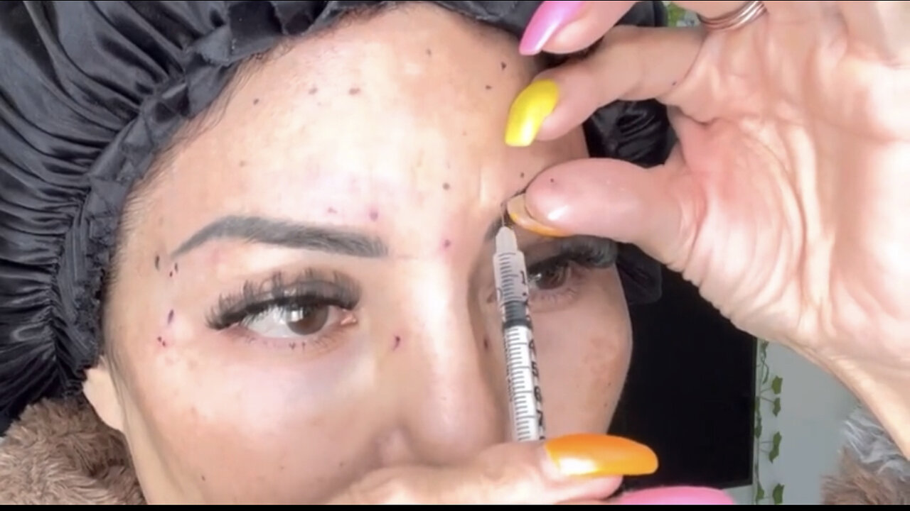 Toxin Touch Up Pattern And Techniques